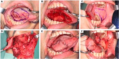 Contralateral facial artery myomucosal island flap for the reconstruction of T2-T3 oncologic oral defects